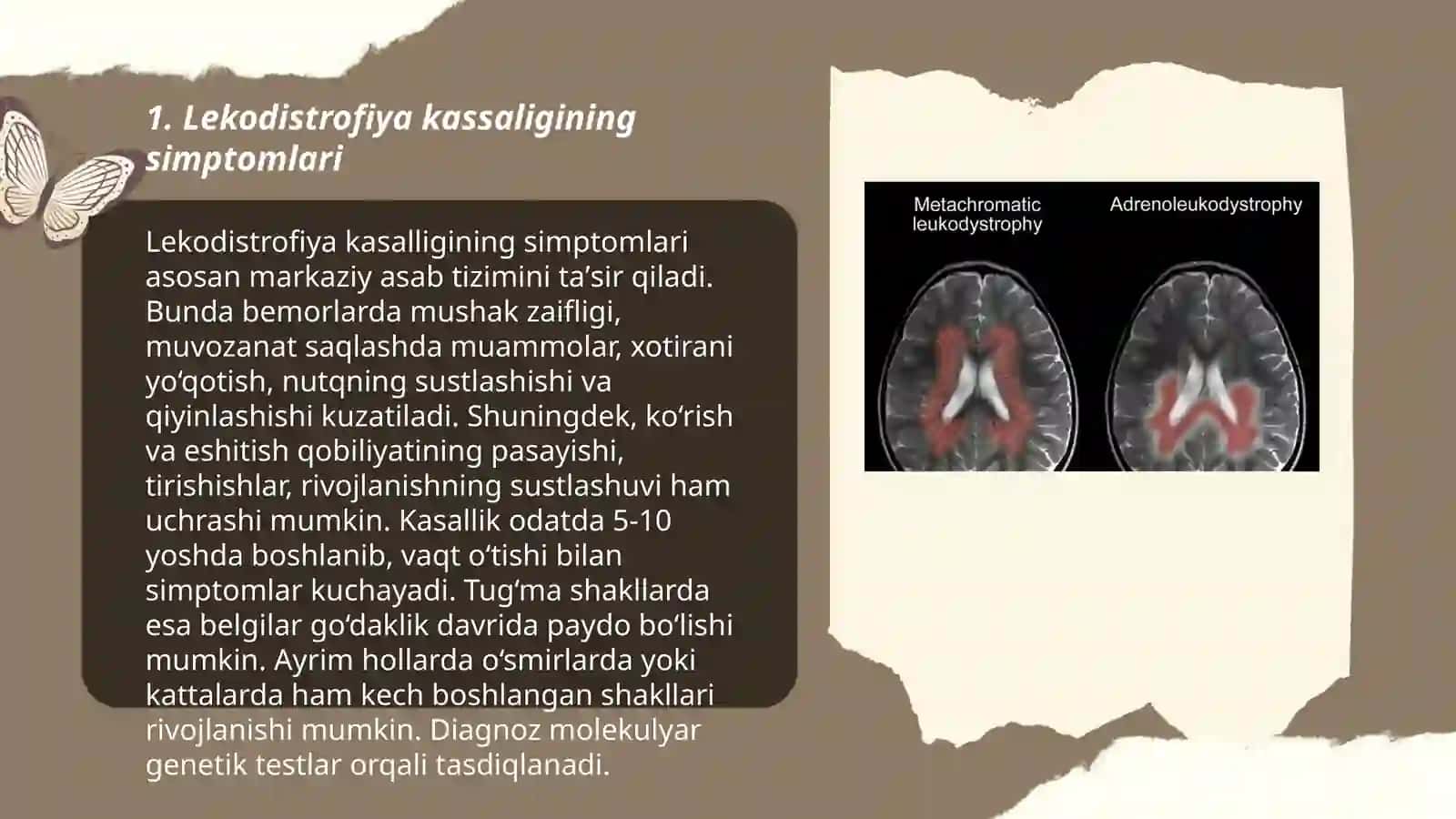 Lekodistrofiya kassaligi 3