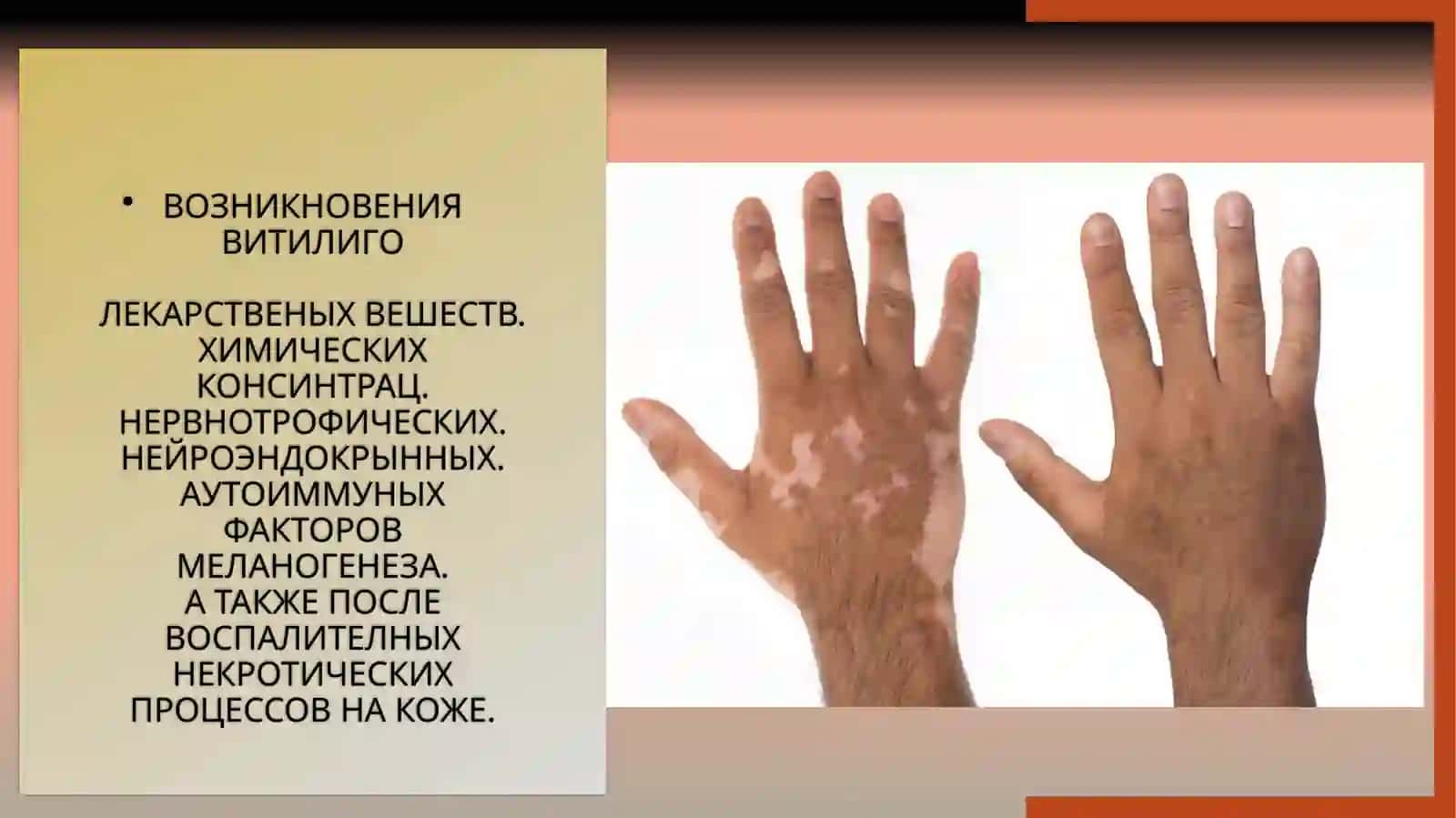 Витилиго 3