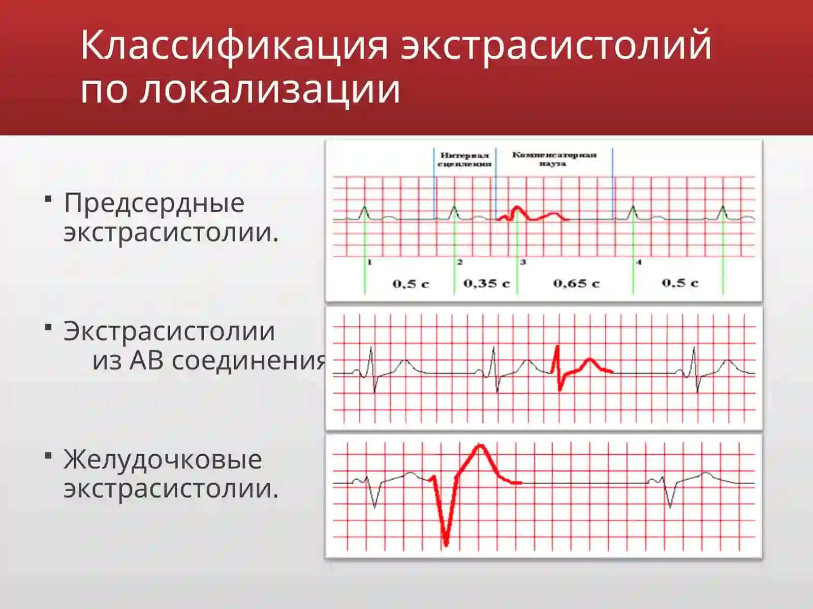 Экстрасистолии 3