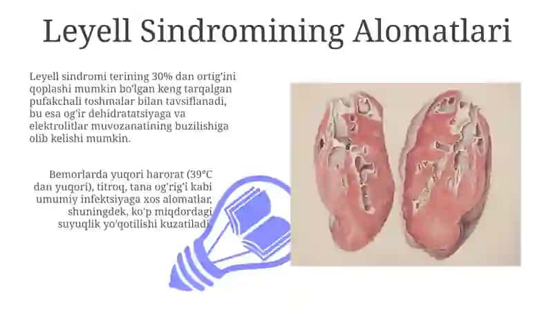 Layell sindromlari 3