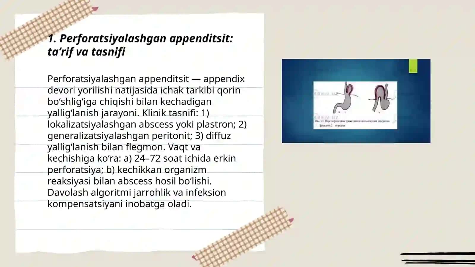 Perforatsiyalashgan appenditsit: taʼrif va tasnifi 3