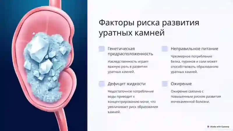 Образование уратных камней в почках, принципы лечения 3
