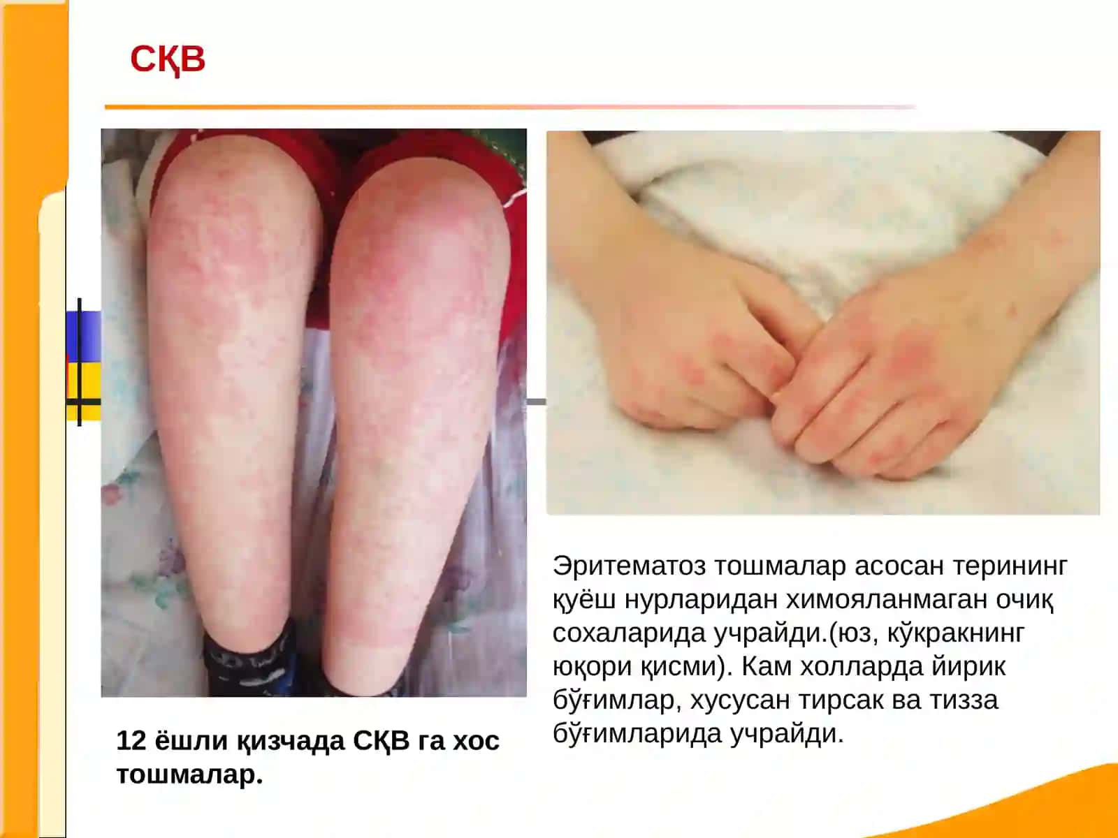 Системаликизил волчанка 3