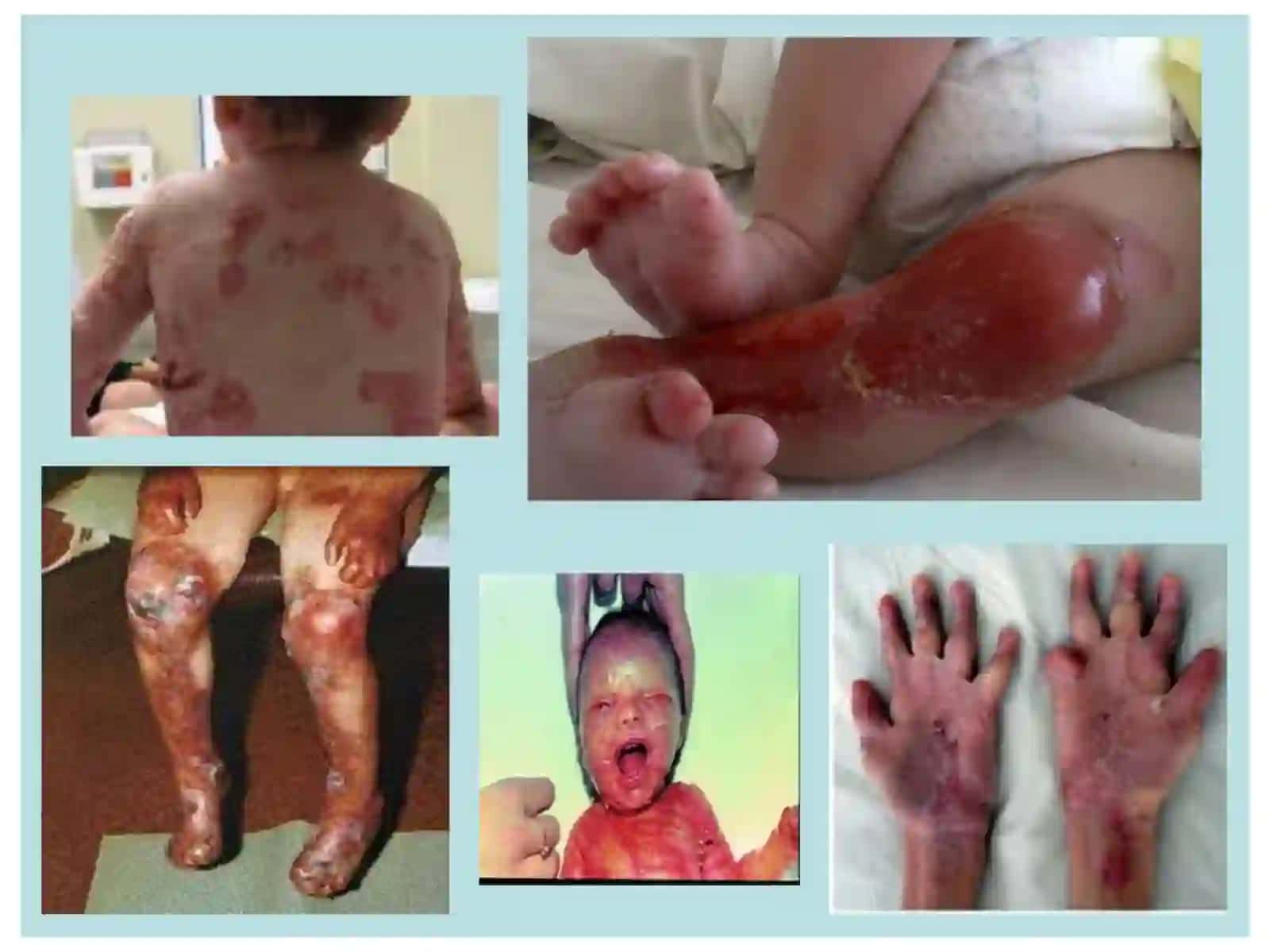 Bullyoz epidermoliz. Xeyli- Xeyli kasalligi 3