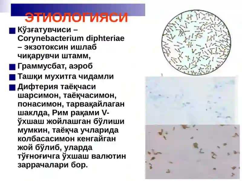 Бўғма – Дифтерия 3