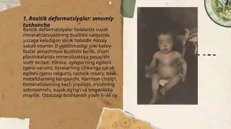 Raxitik deformatsiyalar 3