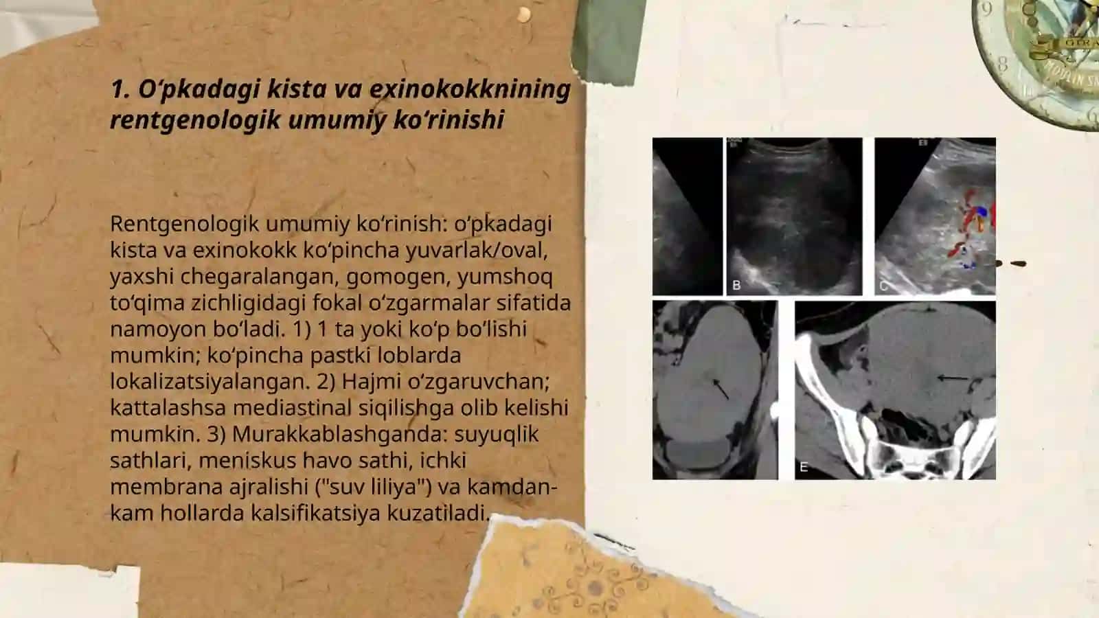O‘PKADAGI KISTA VA EXINOKOKKNING RENTGENDIAGNOSTIKASI 3