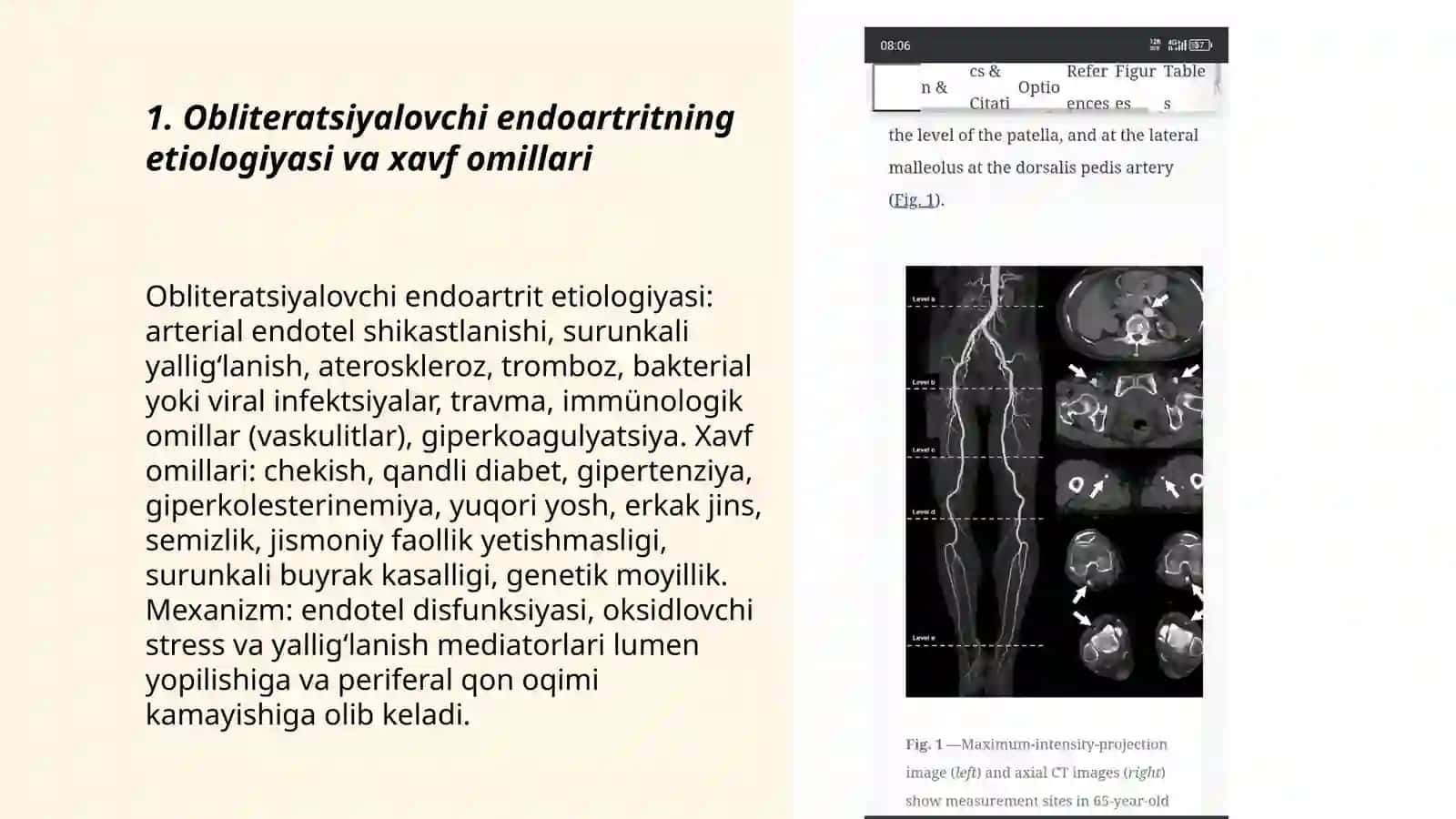 Qon tomir sistemasi kasalliklari obliteratsiyalovchi endoartrit 3