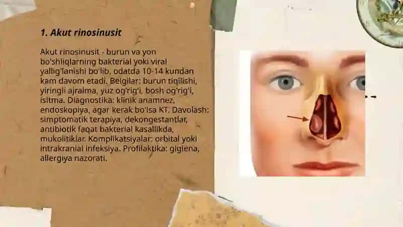 Akut rinosinusit 3