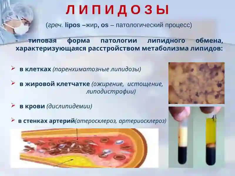 Нарушение обмена фосфолипидов наследственные нарушение жирового обмена 3