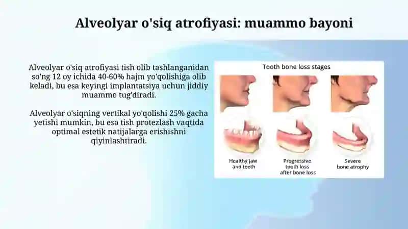 Alveolyar o'siq atrofiyasi 3