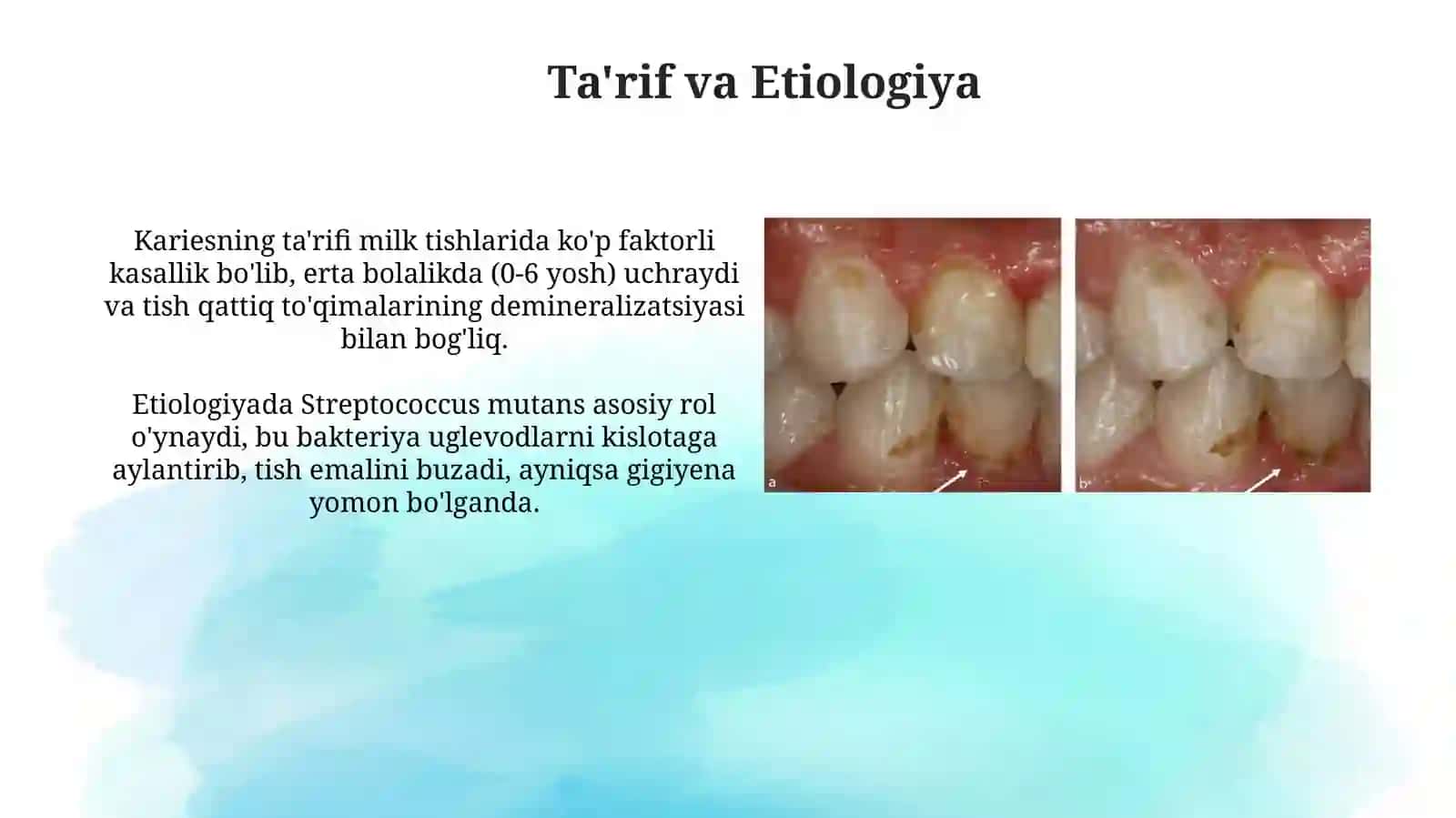 Bolalar stomatologiyasida sut tishlari kariesi 3