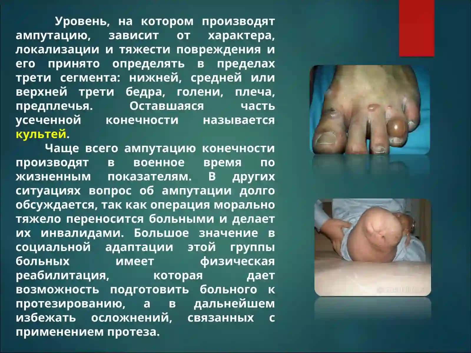 Ампутация протезирование и реабилитация инвалидов 3