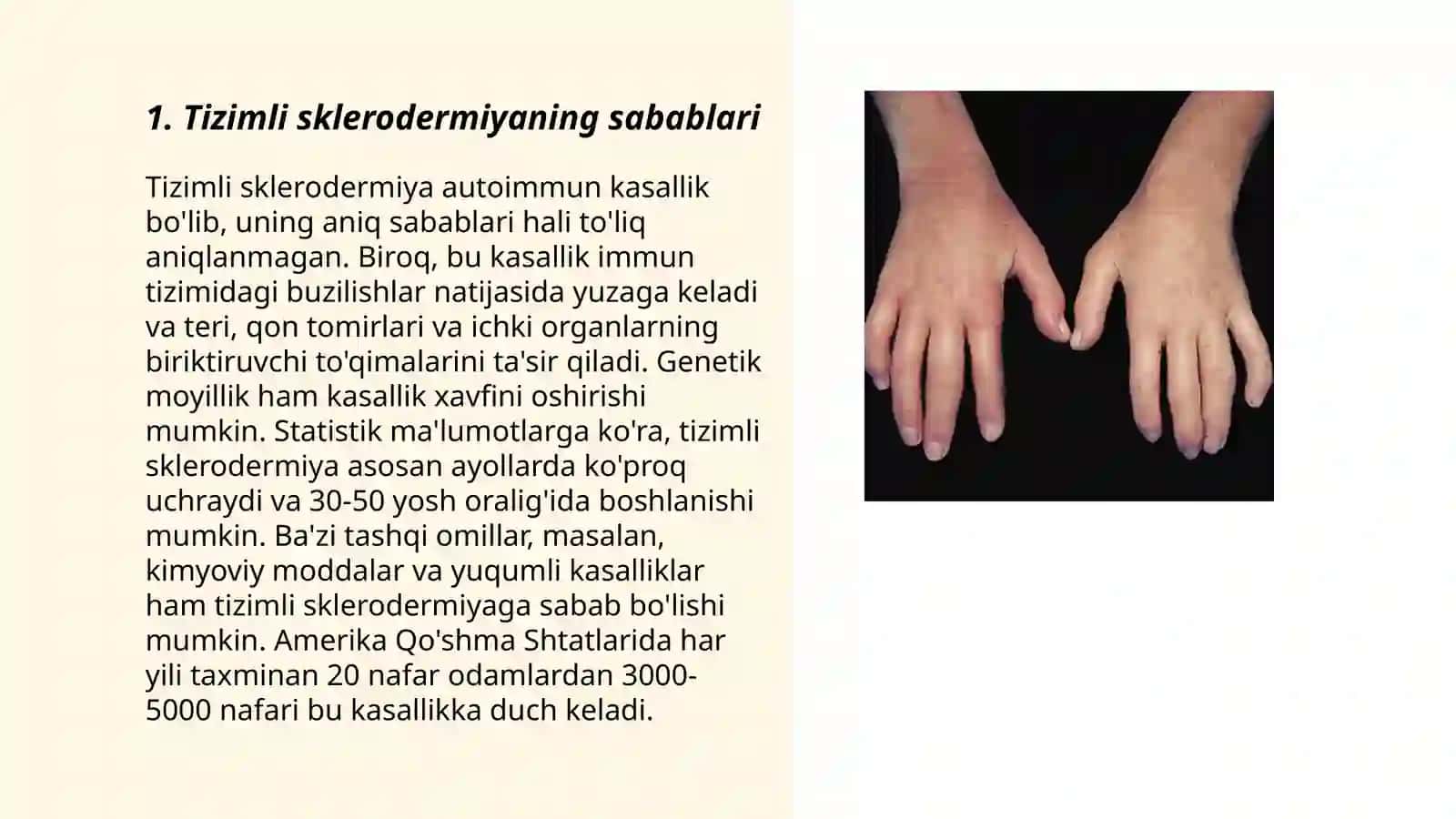 Tizimli sklerodermiya 3