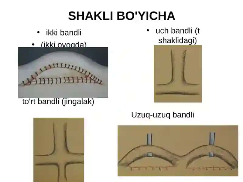 Filatovbandi bilan plastika 3