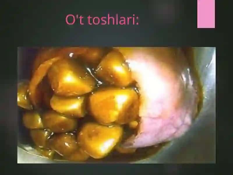 O’T-TOSH KASALLIGI 3
