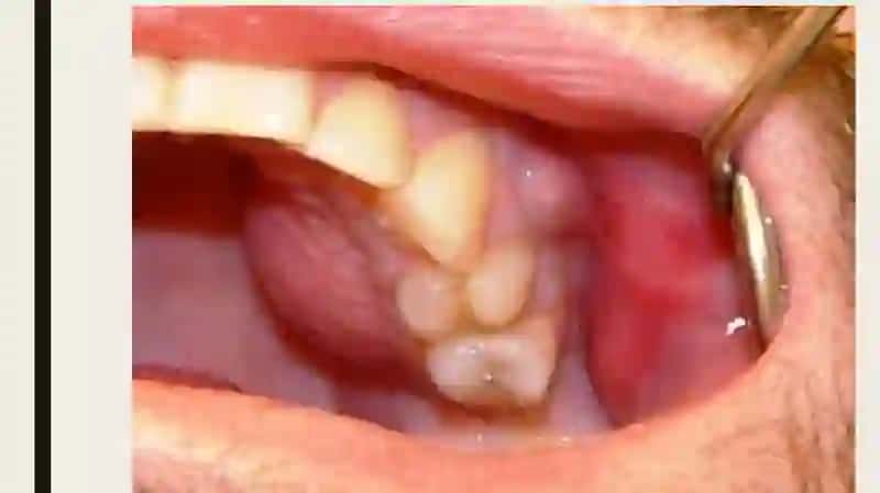 Bolalarda surunkali odontogen osteomiyelitni davolashalgoritmi (sekvestrektomiyaga tayyorlash va operatsiyaxususiyatlari) 3