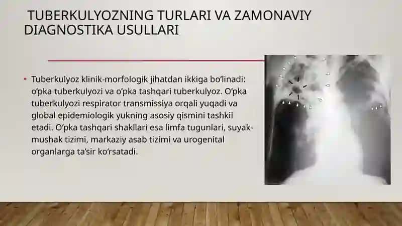 Tuberkulyoz (TB) - MDR va XDR- TB ni Davolash Tamojillari va Usullari 3