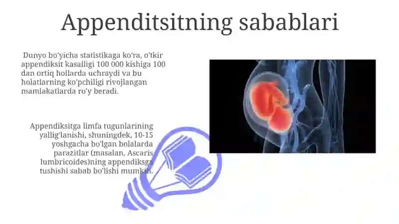 Appendisitning tashxisi va davolash usullari 3