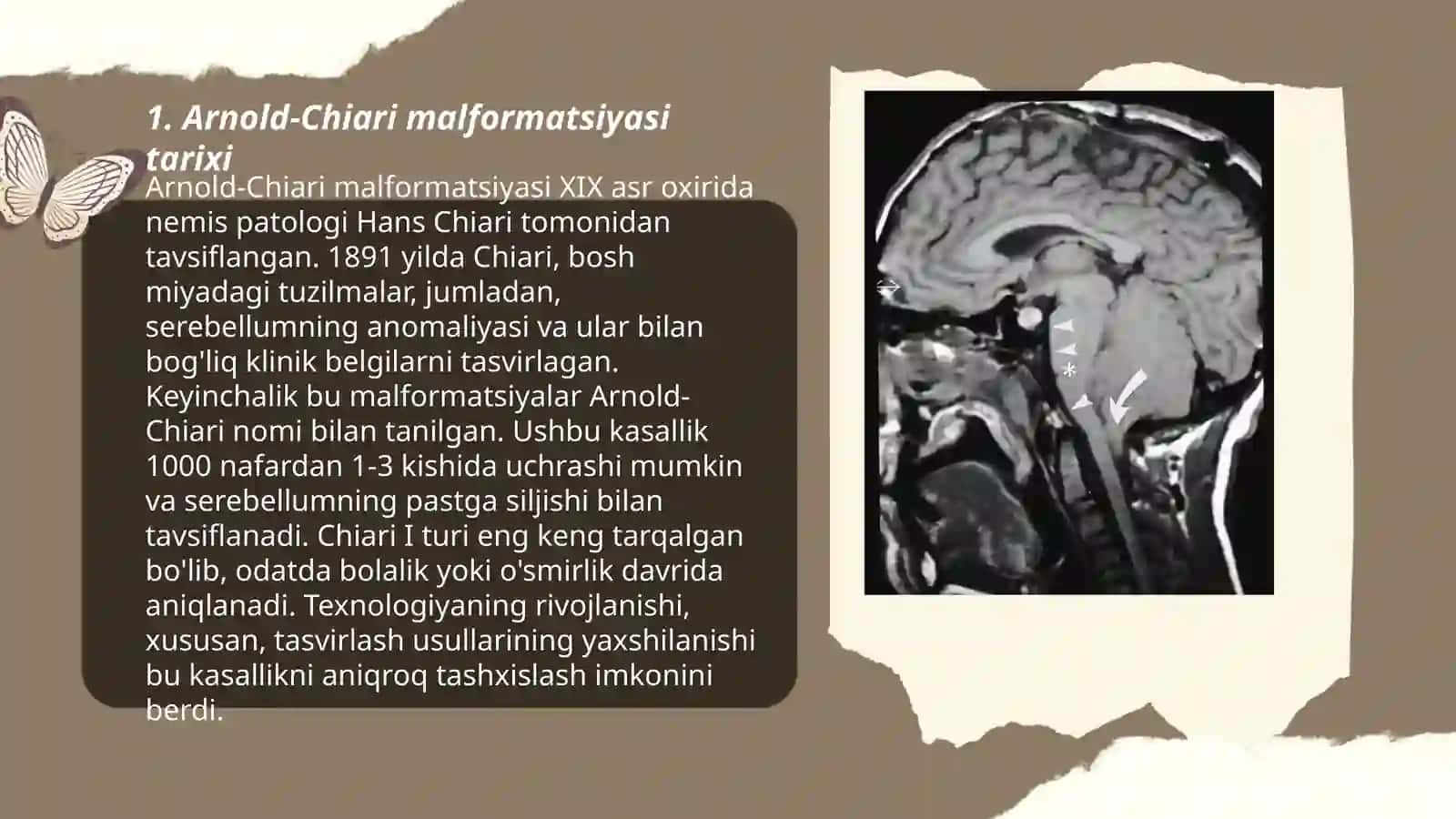 Arnold- Kiari malformatsiyasi kelib chiqish sabablari, diagnostikasi va davolash prinsiplari 3