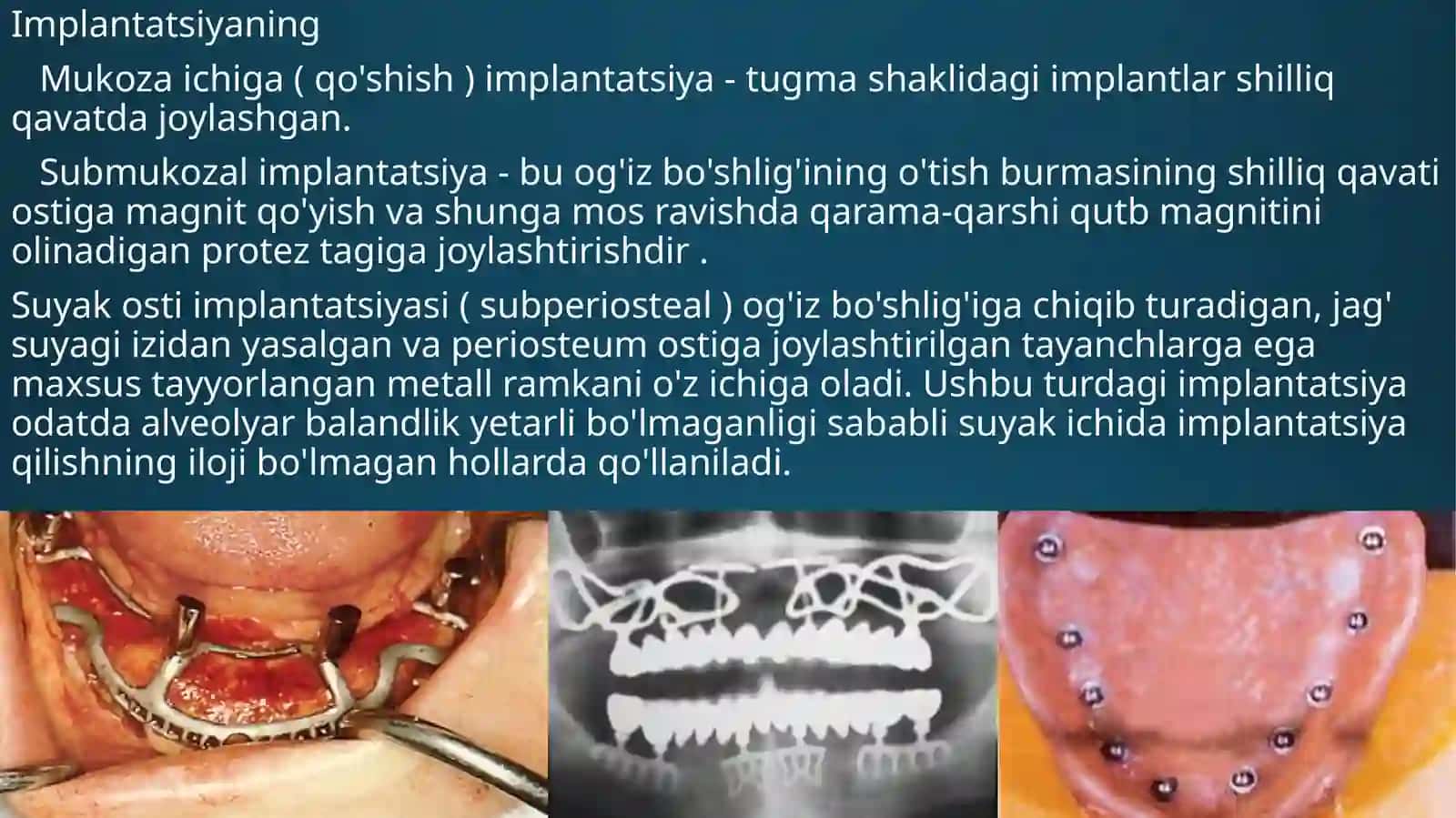 " Implantlardagi olinadigan protezlarni mahkamlash " 3