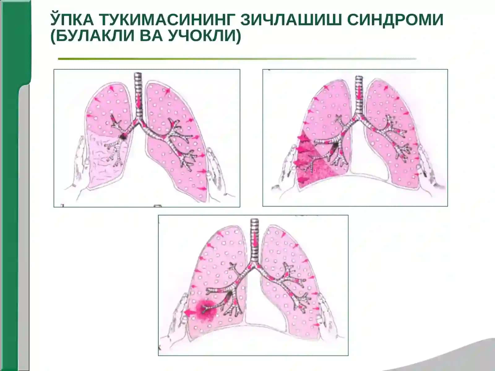 УПКА ТУКИМАСИНИНГ ЗИЧЛАШИШ СИНДРОМИ (БУЛАКЛИ ВА УЧОКЛИ) 3