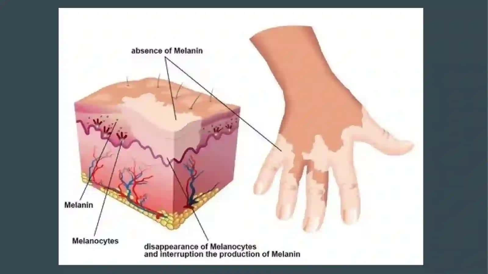 VITILIGO VA UNING ZAMONAVIY DAVOLASH USULLARI 3