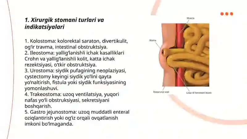 Xirurgik stomani parvarish qilish 3