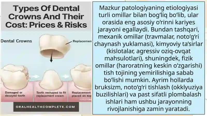 Tish tojining qisman yemirilishi. Qattiq to' qimalarning shikastlanish tasnifi. Etiologiyasi, patogenezi, klinik ko'rinishi.Tish nuqsonlarining xalqaro tasnifi. Tishlarning anatomık shaklini tiklaydigan protez turlari.Qistirmalar tasnifi. 3