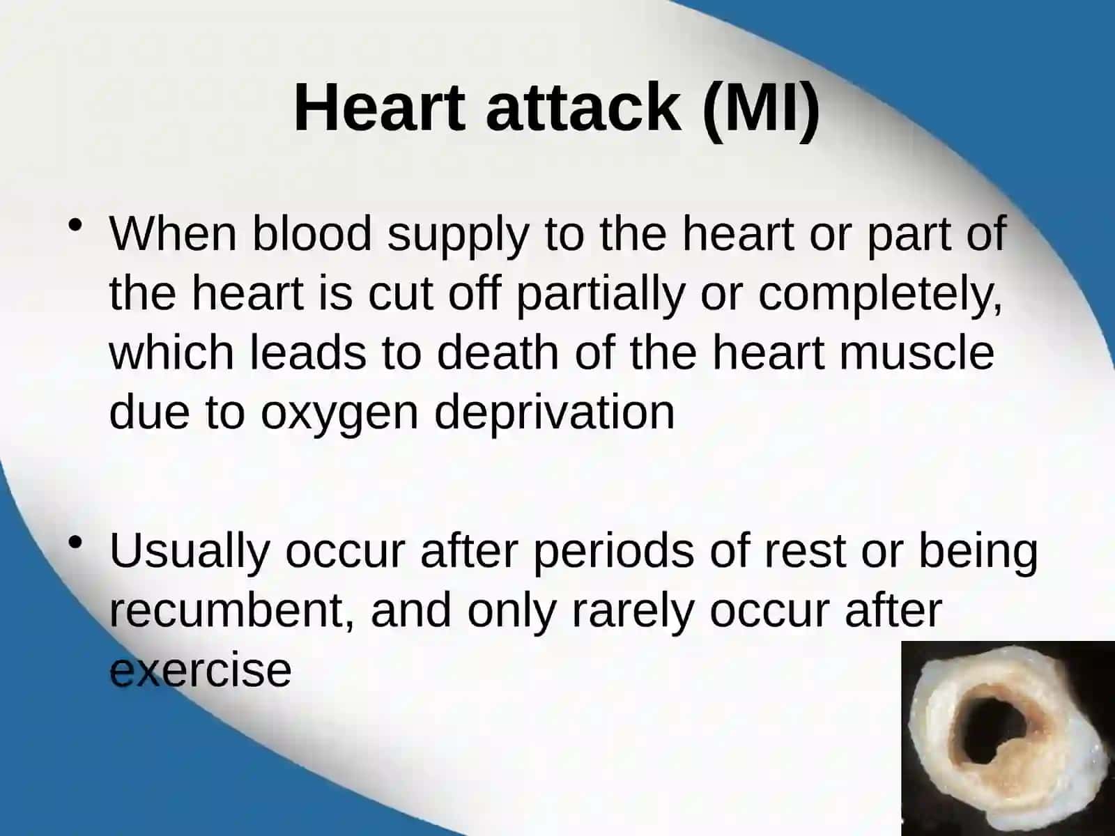 Heart attack (MI) 3