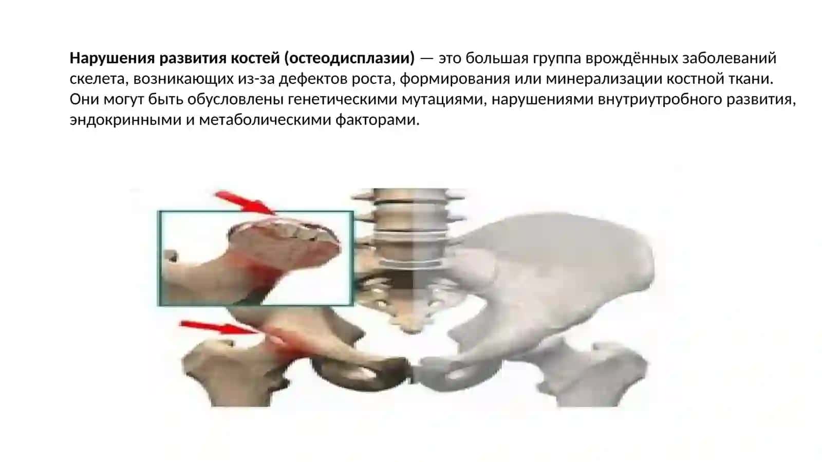 Нарушения развития костей. Переломы.Остеонекроз 3