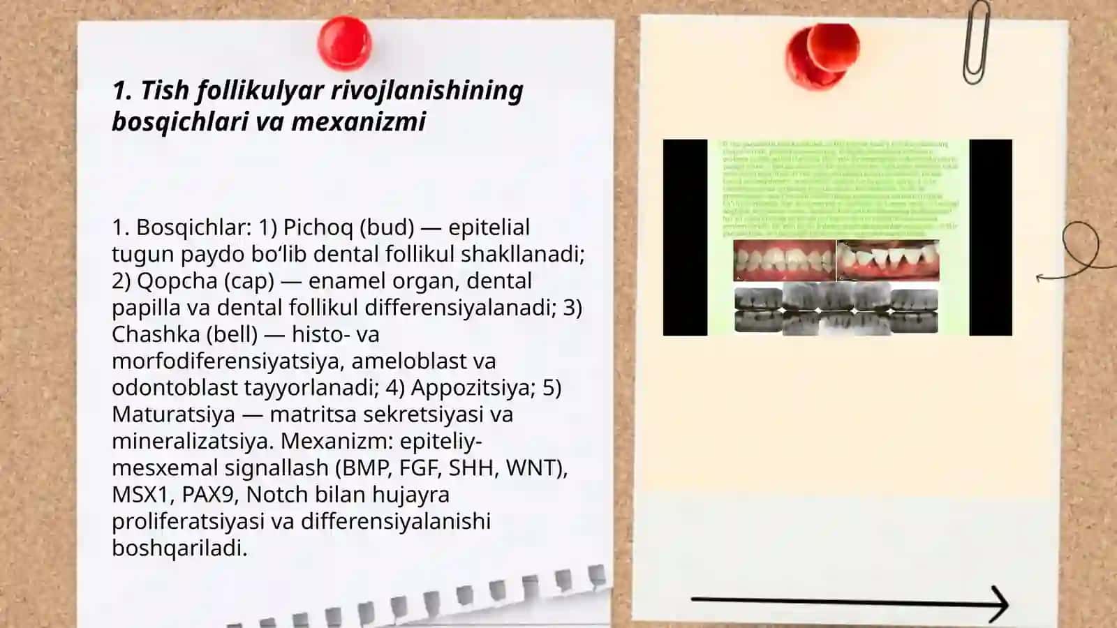Tishlarni follikulyar rivojlanish davridagi zararlanishi.Endimik flyuoroz 3