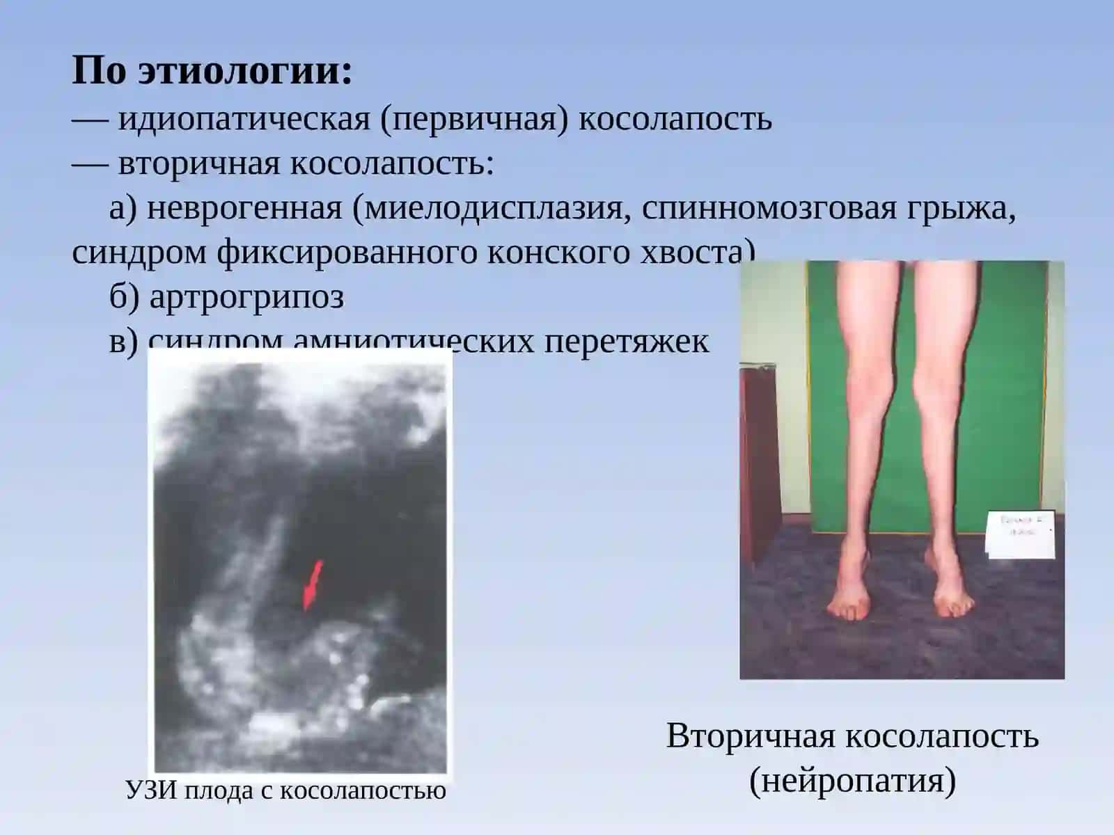 Врожденная косолапость (Congenital talipes equinovarus) 3