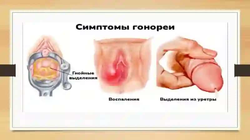 Gonoreya (so`zak) etio-patogenezi, klinikasi,diagnostikasi va davolashi 3