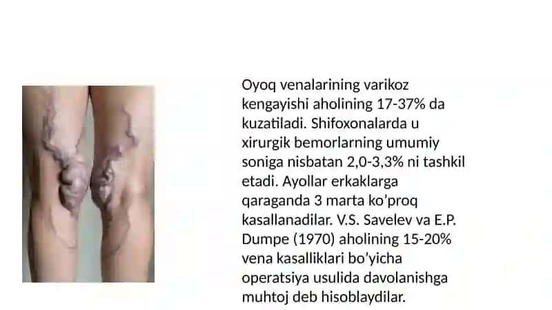 Oyoq venalari varikoz kasalligida bajariladigan operatsiyalar 3