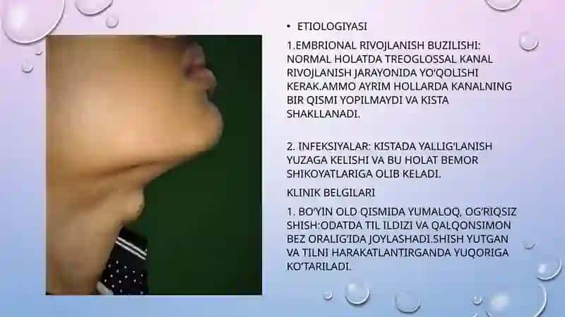 Treoglossal kanal kistalari 3
