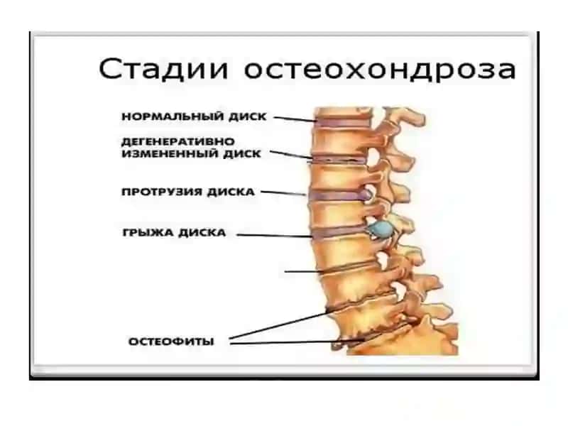 Umurtqalararo diskning anatomiyasi 3