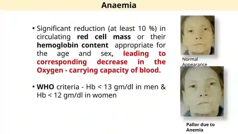 Anemia 3