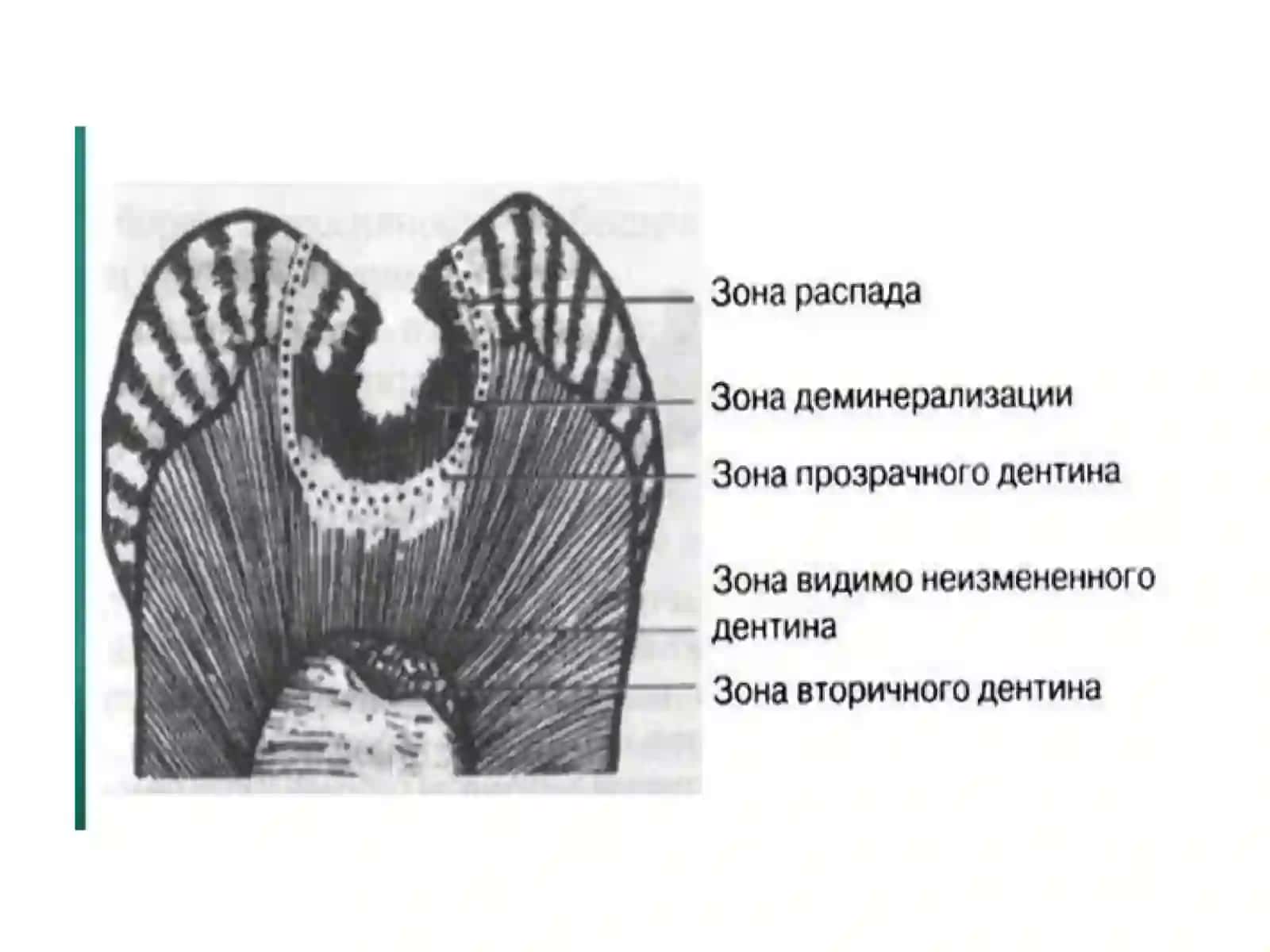 Тиш қаттиқ тўқималарини чархлаш босқичлари ва тамойиллари 3