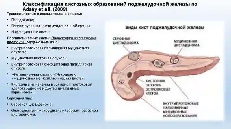 Кисты и кистозные опухоли поджелудочной железы 3