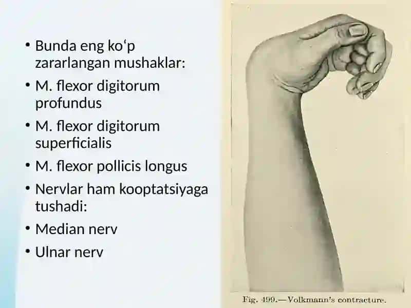 Folkman ishemik kontrakturasi 3