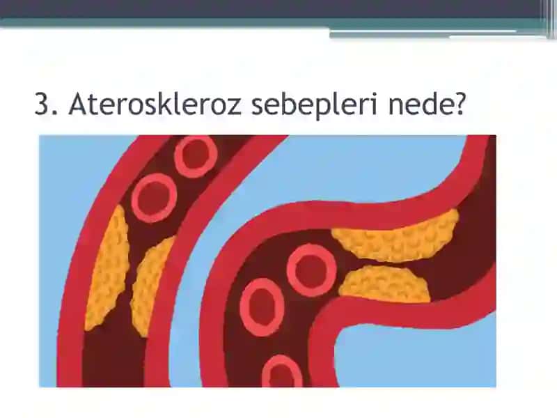 Ateroskleroz 3