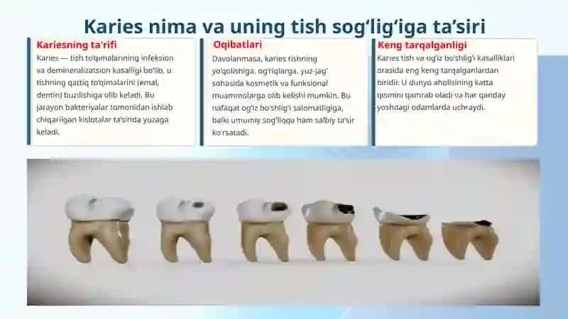 Kariesning umumiy va mahalliy profilaktikasi 3