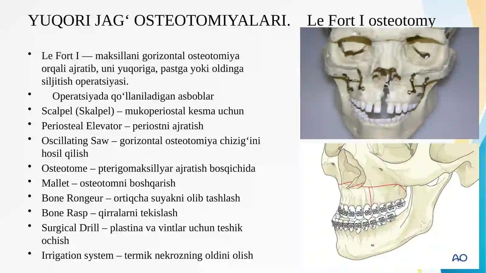 Osteotomiyada ishlatiladigan asbob-anjomlar   Остеотомияда ишлатиладиган инструментлар  LEFOR 1,2,3 tip boyicha,pastki jagda segmentli osteotomiya, BRIDE usuli bo’yicha osteotomiya 3