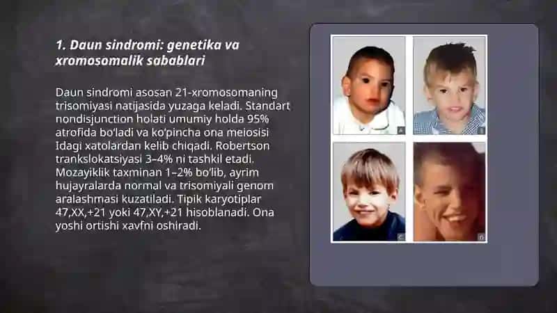 Daun sindromi: genetika va xromosomalik sabablari 3