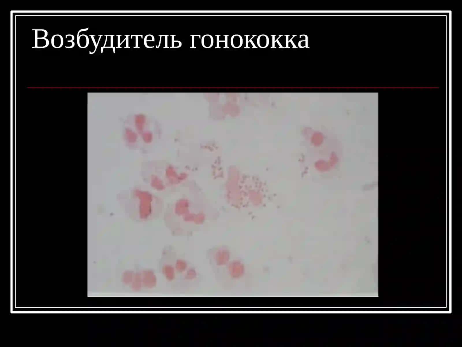 Гонорея 3