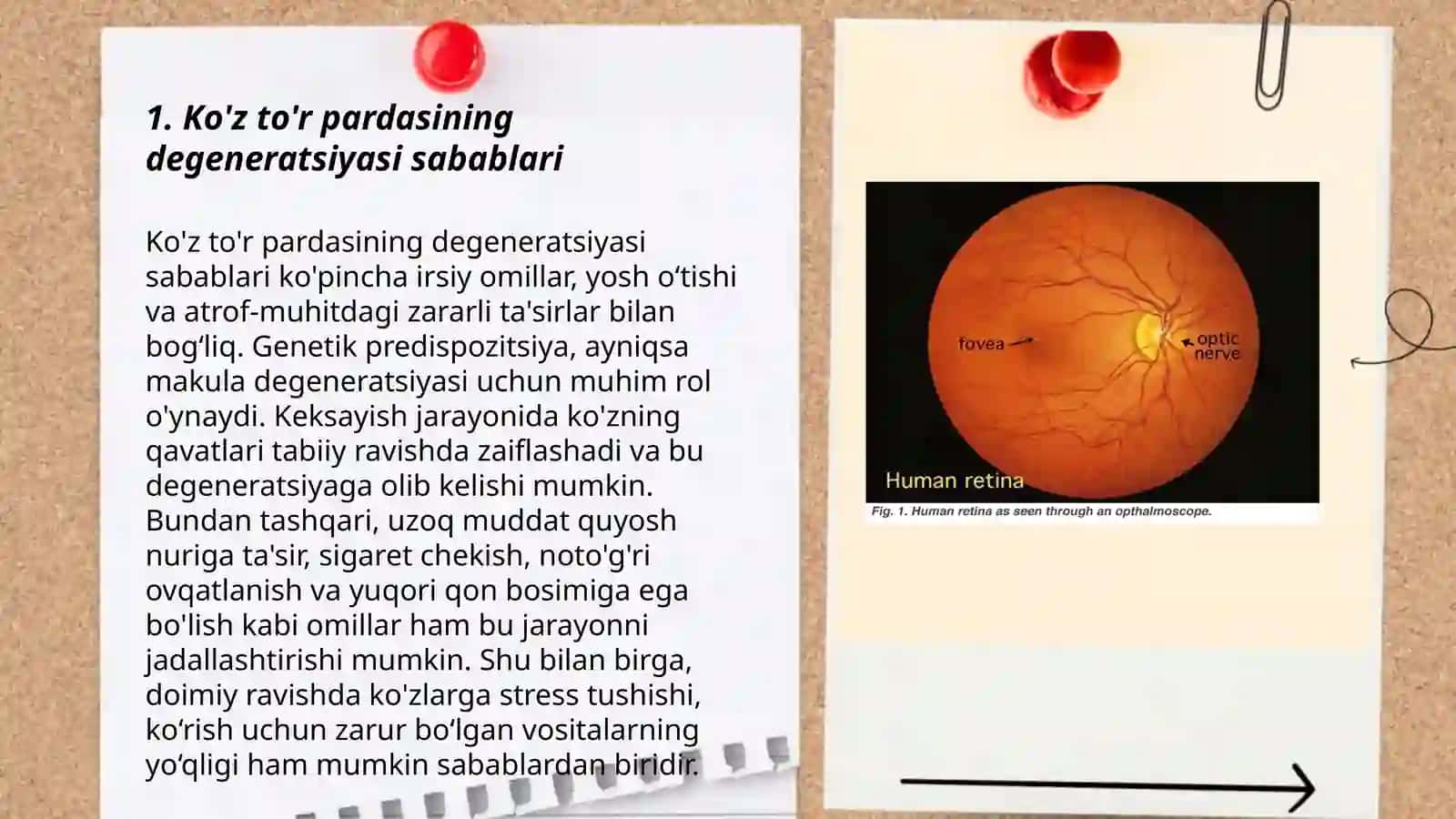 Ko'z to'r pardasining degenerativ kasalliklari 3