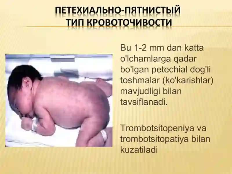 TROMBOCITOPENIYALAR VA GEMOFILIYA 3