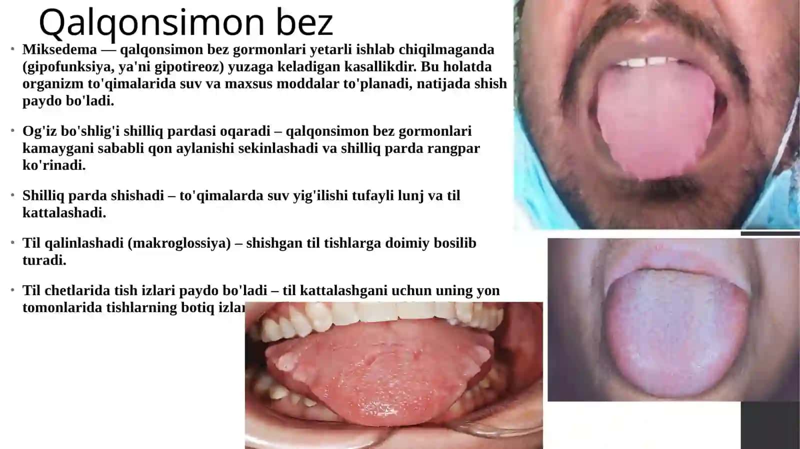 Endokrin bezlar folyatini buzilishining ogʻiz boʻshligʻiga tasiri 3