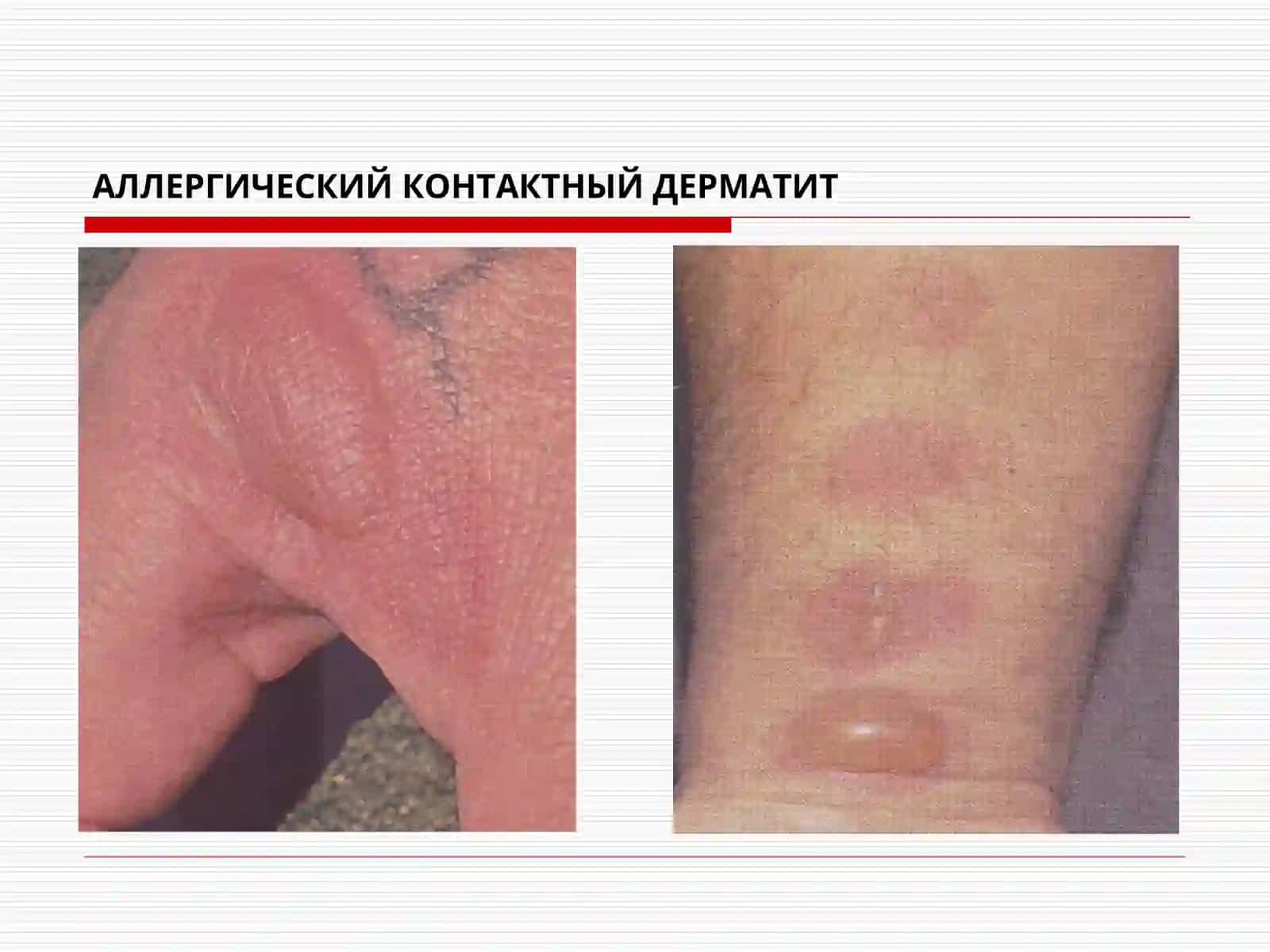 Allergo va neyrodermatozlar 3